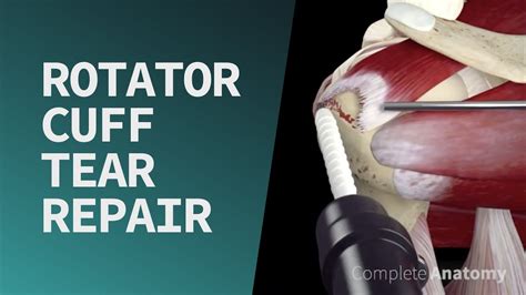 best test for rotator cuff tear repair|how do i know if need rotator cuff surgery.